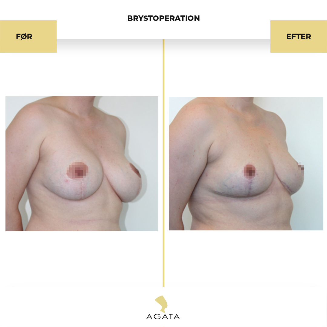 before_after_instagram_template_Brystbrystoperation-copy