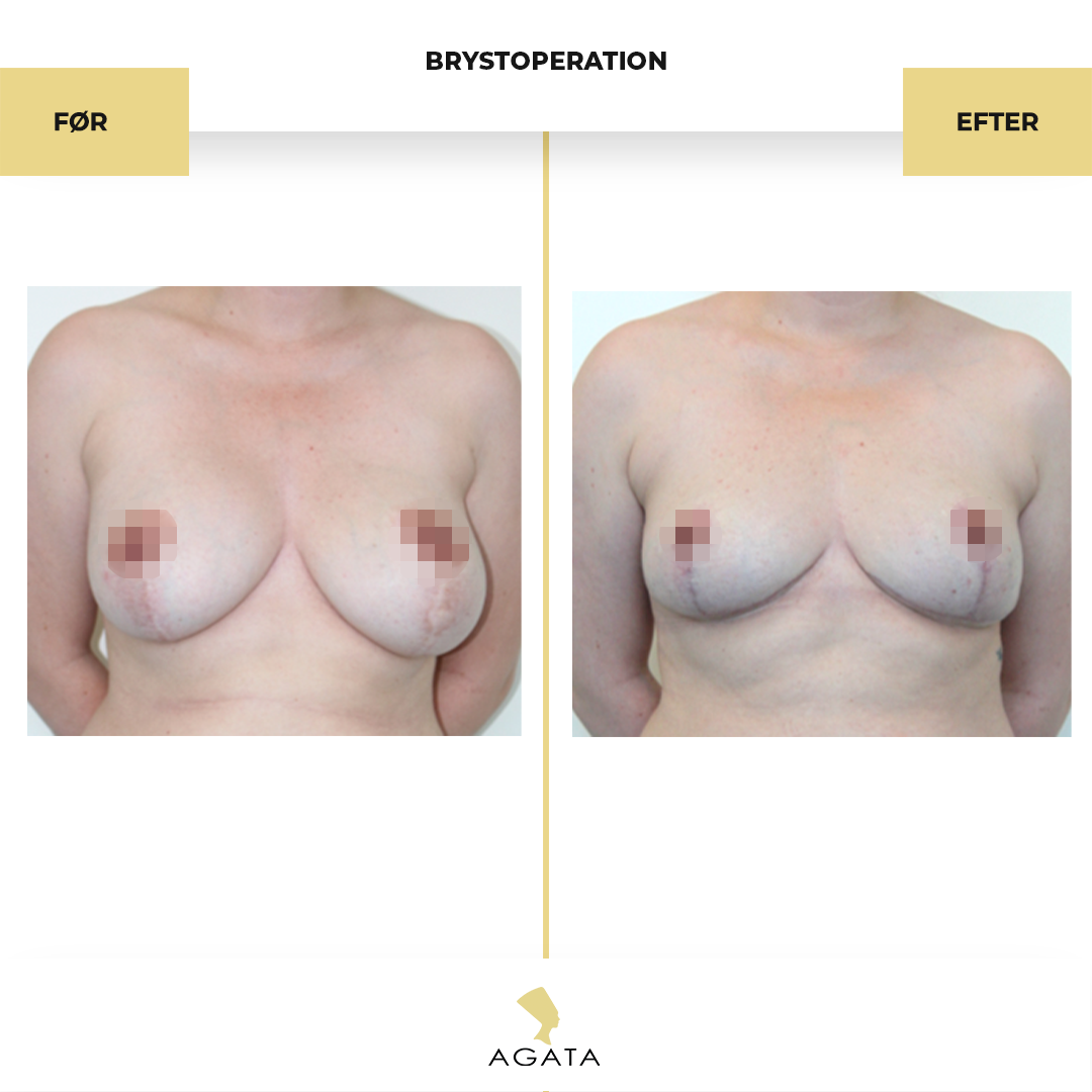 before_after_instagram_template_Brystbrystoperation