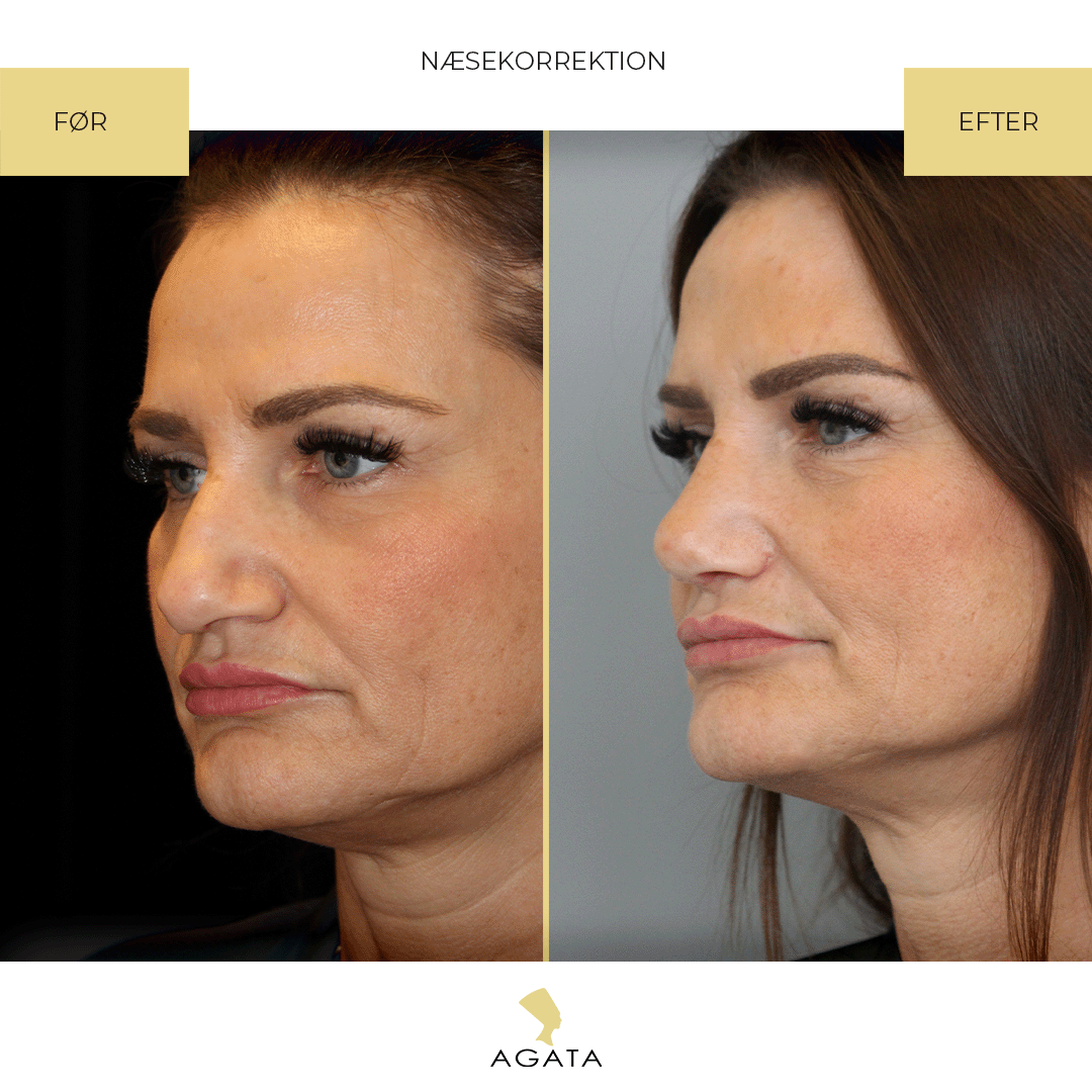 før efter rhinoplastik agata privathospital