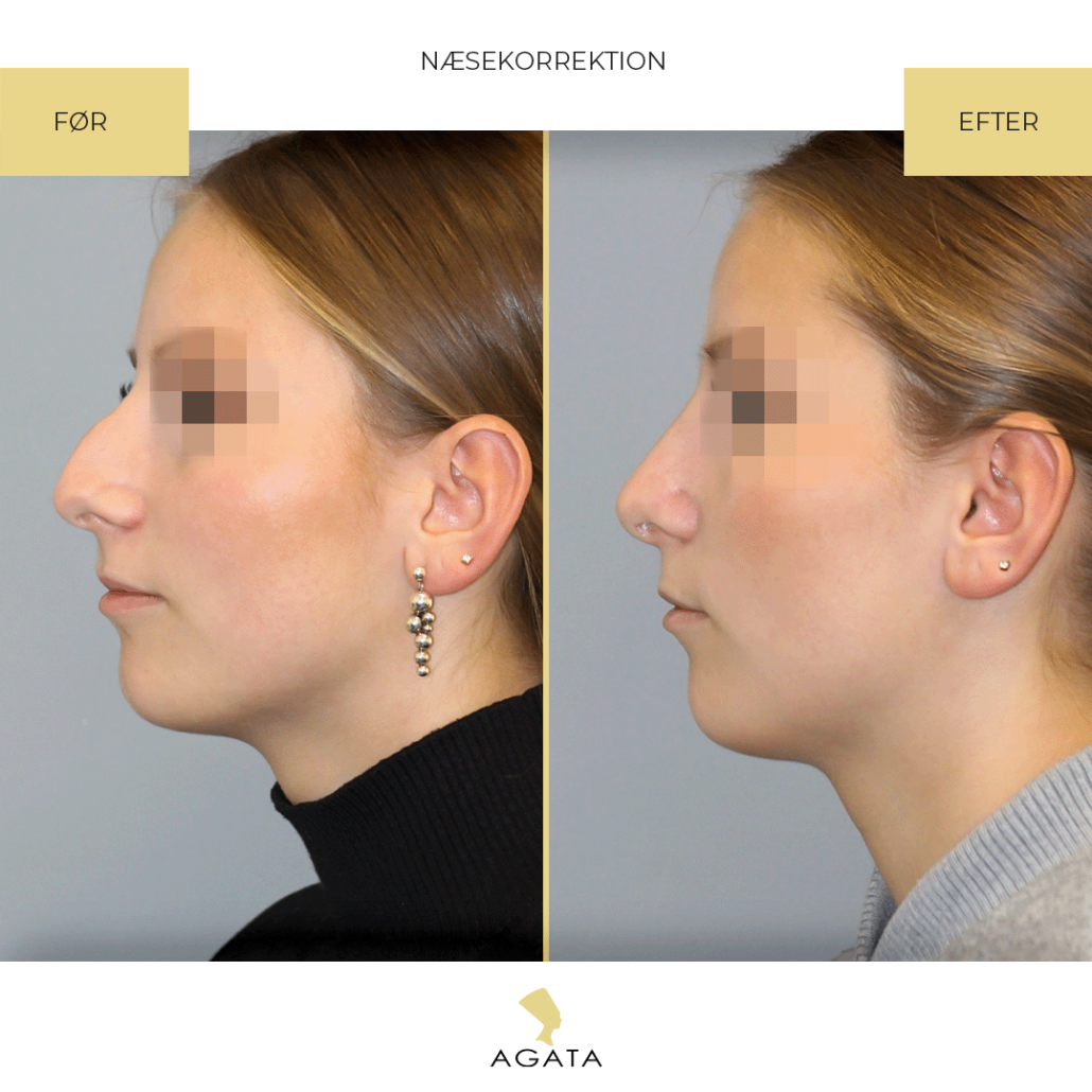før efter rhinoplastik agata privathospital